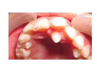 Hyperdontia