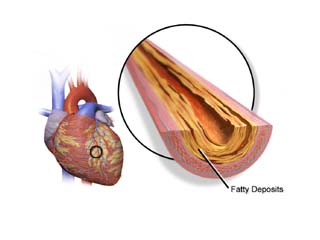 Cardiovascular disease