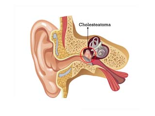 Cholesteatoma