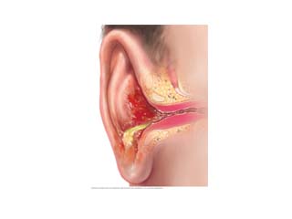 Ear Infection (Otitis Media)