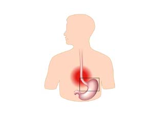 Gastric Reflux