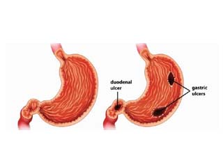 Peptic Ulcer Disease