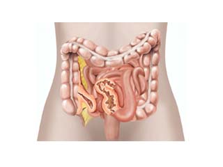 Crohn’s Disease