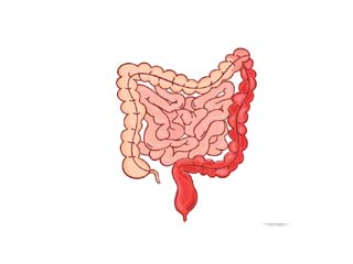 Ulcerative Colitis