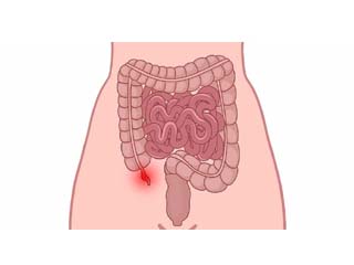 Laparoscopy