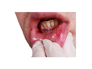 Oral Cancer