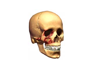 Facial Fractures