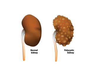 Polycystic kidney disorder