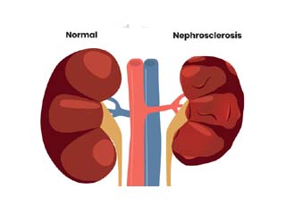 Renal insufficiency