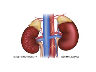 Diabetic kidney disorder