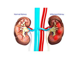 Lupus nephritis