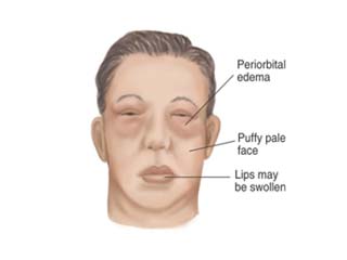 Nephrotic syndrome