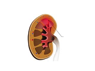 Glomerulonephritis