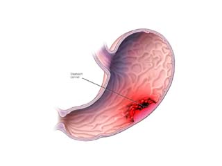 Gastrointestinal cancer