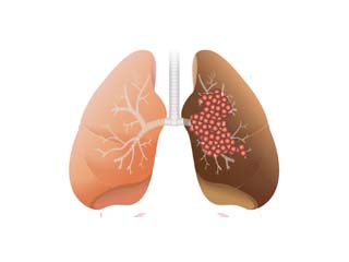 Lung cancer