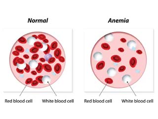 Anemia