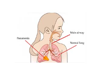 Pneumonia