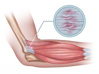 Physiotherapy disease