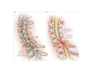 Spine Surgery