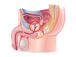 Urology disease